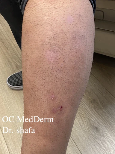 After Leg psoriasis Treatment Irvine Orange County