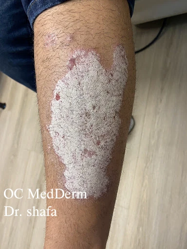Before Leg psoriasis Treatment Irvine Orange County